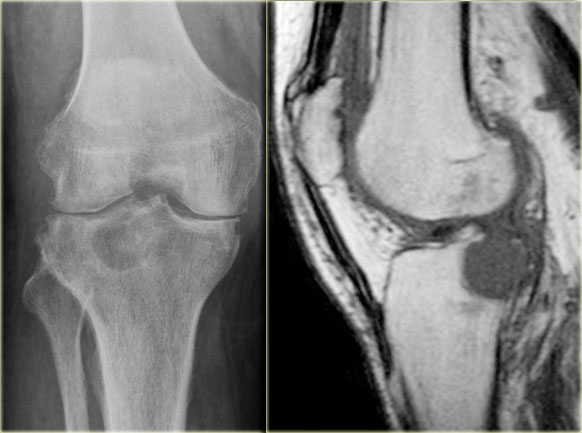 Degenerative cyst or Geode