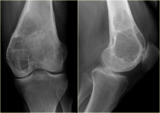 GCT in distal femur