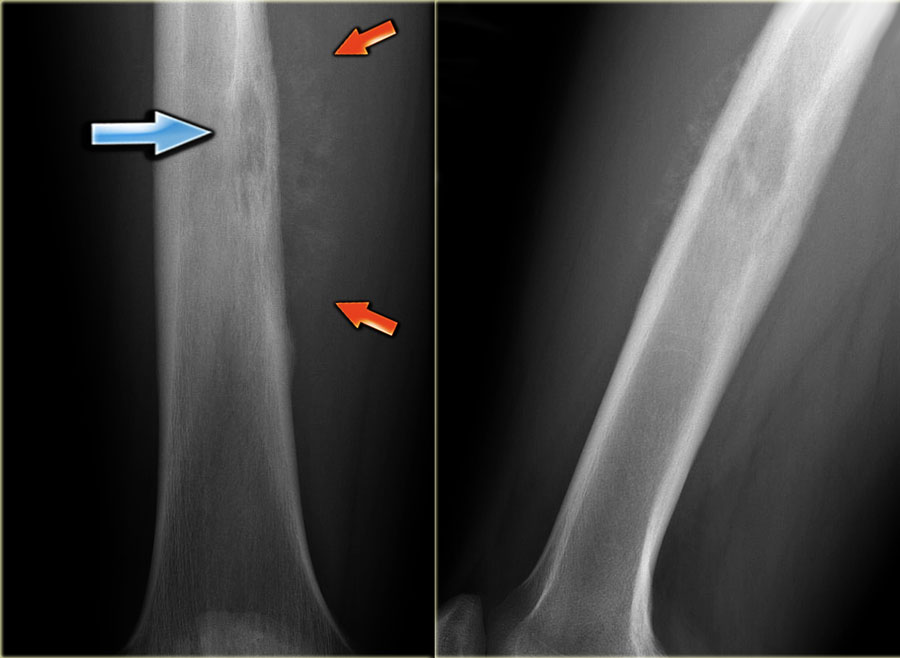 Ewing's sarcoma in diaphysis of the femur. Notice ill-defined zone of transition (blue arrow) and aggressive type of periosteal reaction (red arrows)