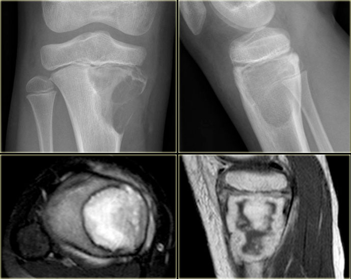 Chondromyxoid Fibroma