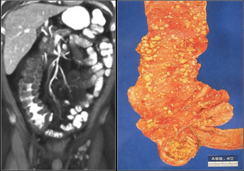 Pseudomembranous Colitis