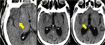 Two patients with insular ribbon sign