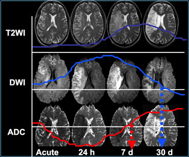 Signal intensities on T2WI and DWI in time (courtesy Dr M. Law)