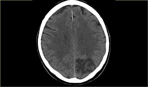 PCA infarction