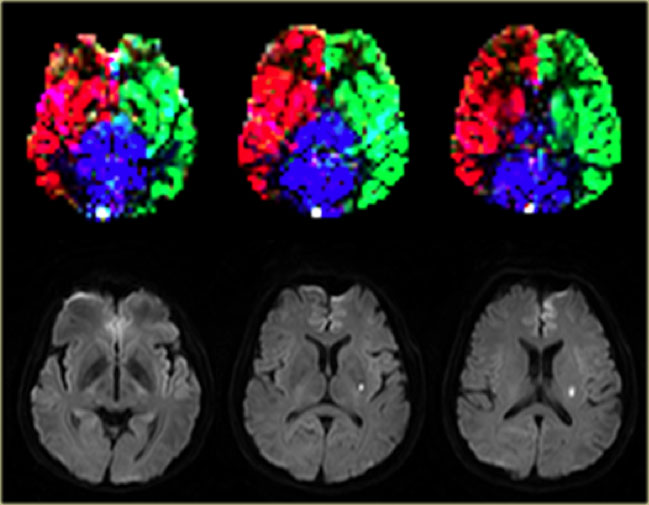 Normal perfusion territories in a patient with a lacunar infarction Images courtesy Jeroen Hendrikse (9)