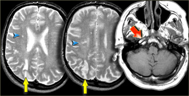 Borderzone infarcts due to occlusion of the internal carotid