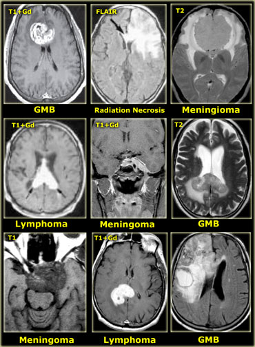 Tumors and tumor-like masses that cross the midline