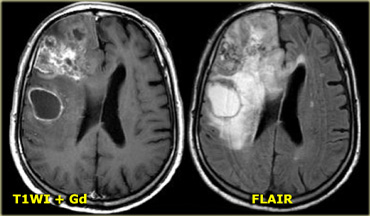 GBM with patchy enhancement and cystic component with ring enhancement