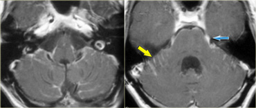 Leptomeningeal metastases