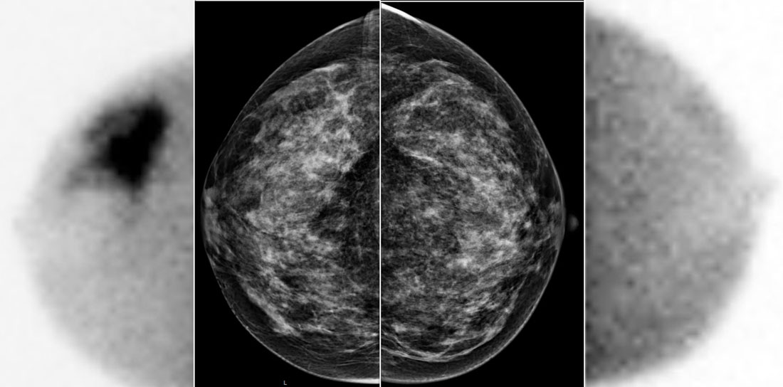 A large tumor in the  right breast is easily detected with  BSGI, while hardly visible on the mammogram.