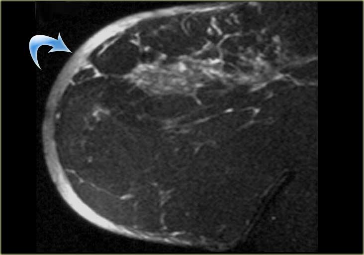 Inflammatory carcinoma with thickening of the skin