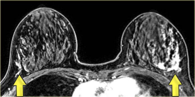 DCIS bilaterally