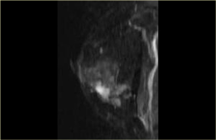 Adenoid cystic carcinoma