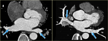 Axial reconstructions showing the pulmonary veins (blue arrows) as they enter the left atrium