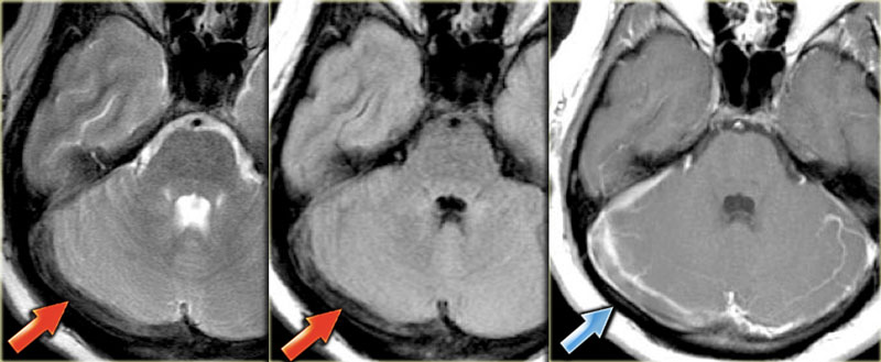 Thrombus in right transverse sinus is dark on T2 due to intracellular deoxyhemoglobin (Courtesy dr. Howard Rowley)