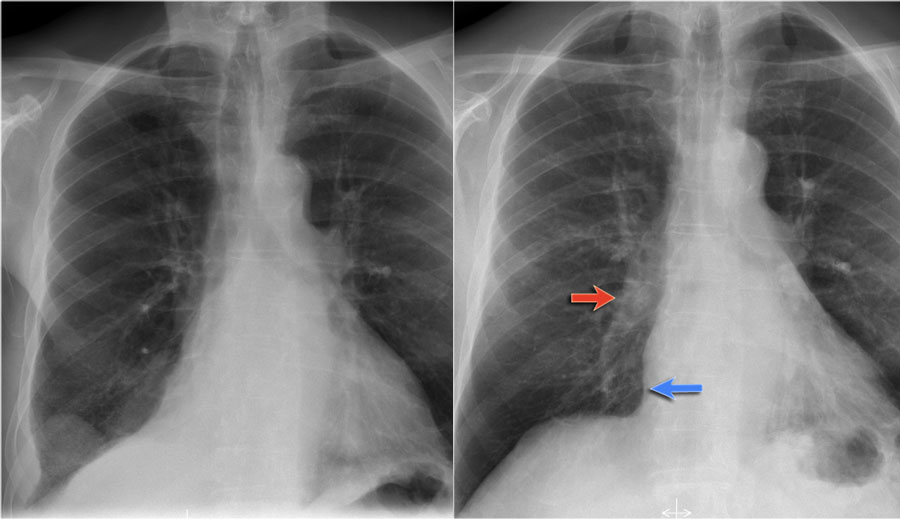 LEFT: Lower lobe atelectasis. RIGHT: Follow up.