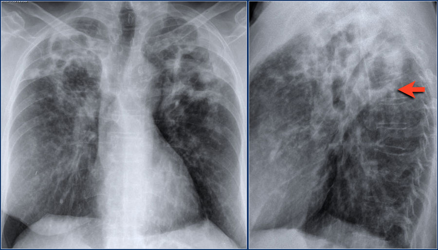 Nontuberculous mycobacteria pneumonia with cavitation