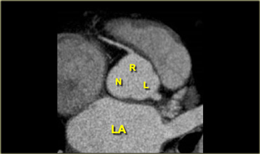 Left coronary (LC), right coronary (RC) and posterior non-coronary (NC) cusp