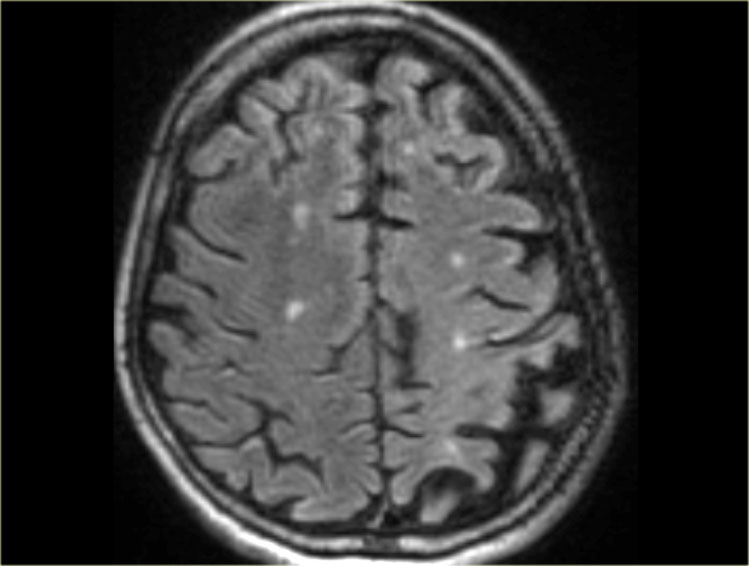 Corticobasal degeneration