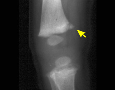 Typical corner fracture very specific for non accidental trauma