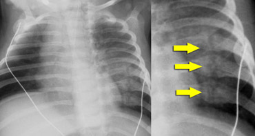 Old posterior rib fractures very indicative of non accidental trauma.