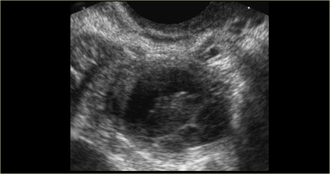 Hemorrhagic cyst