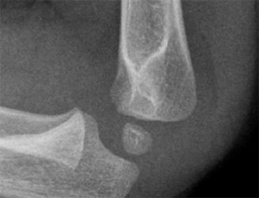 Positive fat pad sign both anteriorly as well as posteriorly.