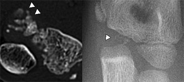 Fragmented appearance of the Trochlea in 2 different children.