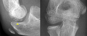 Trochlea ossification-fragments simulate loose bodies in the joint