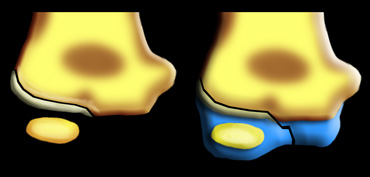 Lateral condyle fracture. On the x-ray only a small metaphyseal fragment is visible. The detatched fragment however is larger than it appears on the radiograph. The fracture extents into the lateral ridge of the trochlea. Elbow is probably unstable.