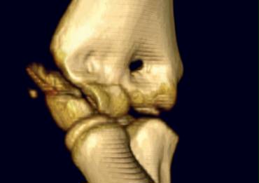 CT reconstruction of displaced lateral condyle fracture. Humeroulnar joint is stable.