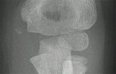 Avulsion of medial epicondyle.