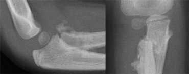 Same patient as above 4 weeks later