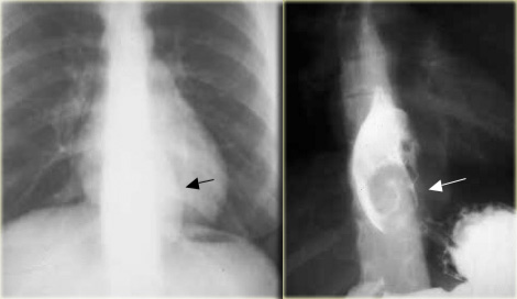 Esophageal leiomyoma