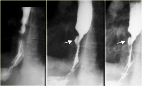 Varicoid carcinoma