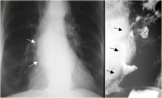 Leiomyosarcoma of the esophagus