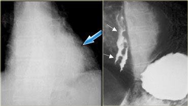 LEFT: Retrocardiac mass-like varices (arrow). RIGHT: Esophagram showing varices (arrows)