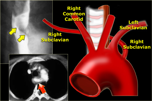 Aberrant right subclavian artery