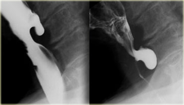 Zenker's diverticulum in early and late phase of swallowing