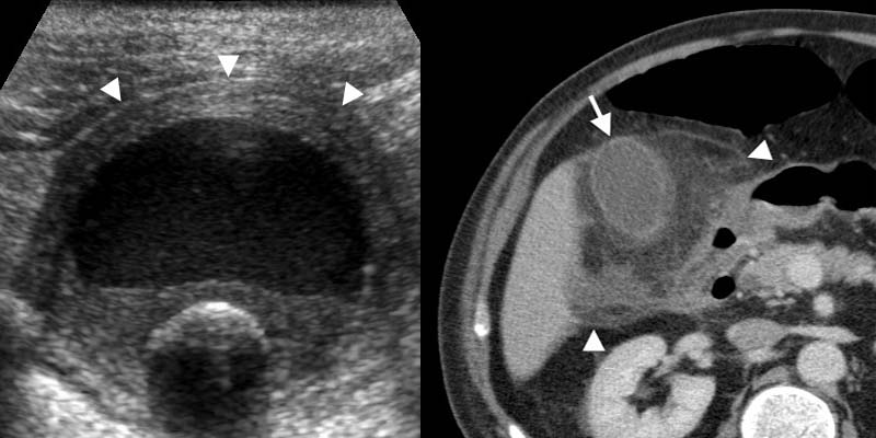 Acute calculous cholecystitis