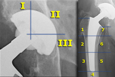 Acetabular zones according to De Lee and CharnleyFemoral zones according to Gruen