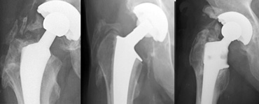 Various degrees of heterotopic ossification