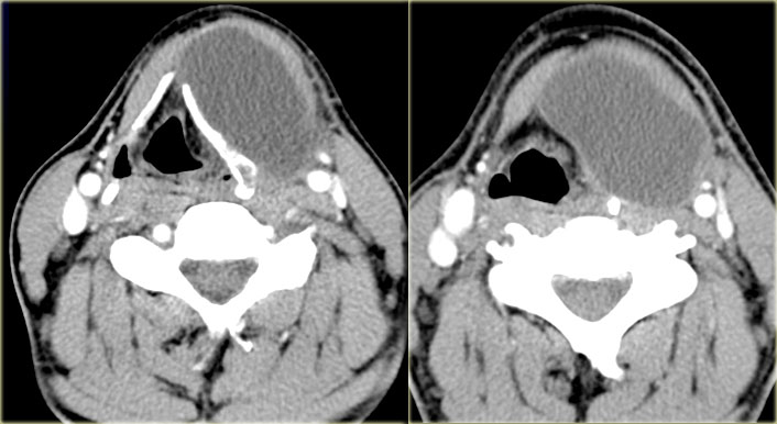 Paramedian thyroglossal duct cyst