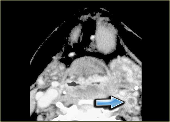 Thrombosis of the left internal jugular vein