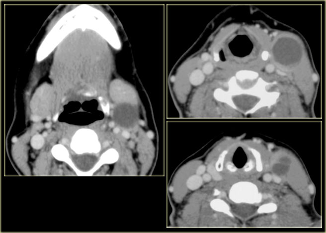 Secondary infected branchial cleft cyst (courtesy Berit Verbist)