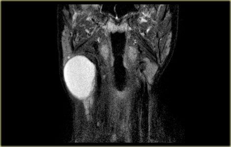 Second branchial cleft cyst: high signal intensity on STIR