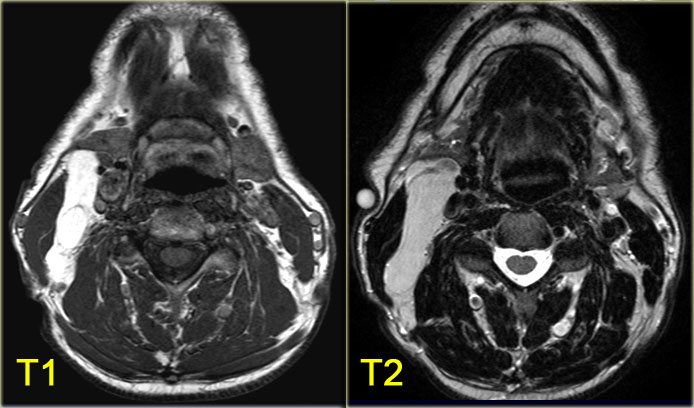 Lipoma in the right posterior cervical space