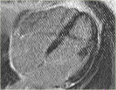 Myocarditis: 10 months later the midmyocardial enhancement of the lateral wall has diminished.