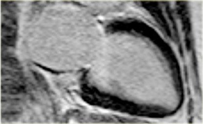 Tako-Tsubo cardiomyopathy: no late enhancement