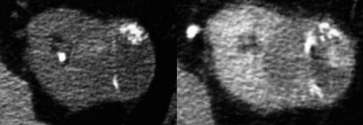 LEFT: NECT with a smooth linear calcification and nodular calcification.RIGHT: Enhanced CT shows enhancement ...... Excise